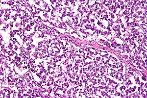 Micrograph of a dysgerminoma, H&E stain
