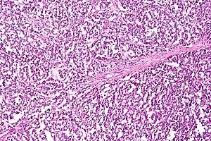 Dysgerminoma characterized by uniform cells separated by fibrous septa with lymphocytes, H&E stain.