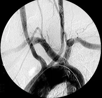 Aberrant right subclavian artery at angiography.
