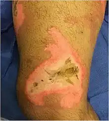 An image of a skin burn to the medial right thigh above the knee of a 35-year-old male.