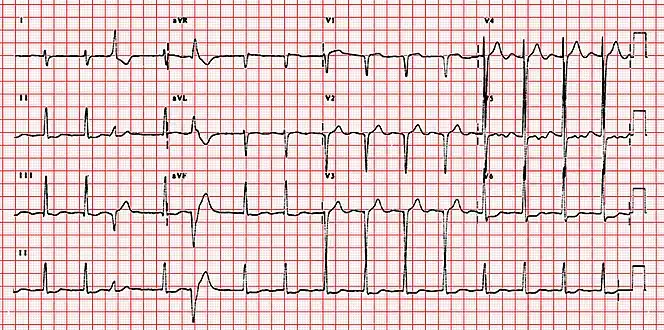 ECG showing right axis deviation