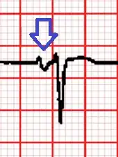 ECG of V1 showing the large negative of the P wave indicating left atrial enlargement