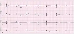 An ECG showing sinus bradycardia at 43 bpm. The image is made up of a red grid on a white background. A black line traces the patients heart beat.