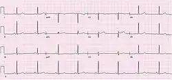Electrocardiogram (ECG) of a 64-year-old female with sinus bradycardia. Heart rate 49 bpm.