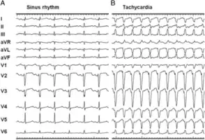 ECGs recorded during sinus rhythm and AVRT in a 9-year-old girl with Ebstein's anomaly and a Mahaim accessory pathway.