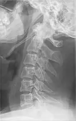 Radiograph, lateral view showing elongated stylohyoid process and stylohyoid ligament ossification