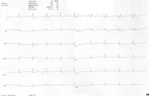 A 10-lead ECG of a woman with Ebstein's anomaly: The ECG shows signs of right atrial enlargement, best seen in V1. Other P waves are broad and tall, these are termed "Himalayan" P waves. Also, a right bundle-branch block pattern and a first-degree atrioventricular block (prolonged PR-interval) due to intra-atrial conduction delay are seen. No evidence of a Kent-bundle is seen in this patient. The T wave inversion in V1-4 and a marked Q wave in III occur; these changes are characteristic for Ebstein's anomaly and do not reflect ischemic ECG changes in this patient.
