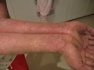 More severe dermatitis