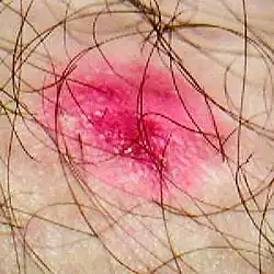 A patch of dermatitis that has been scratched