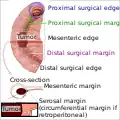 Edges and margins of an intestinal tumor