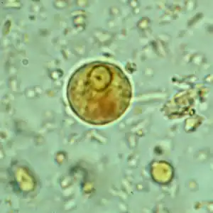Immature E. histolytica/E. dispar cyst in a concentrated wet mount stained with iodine. This early cyst has only one nucleus and a glycogen mass is visible (brown stain).