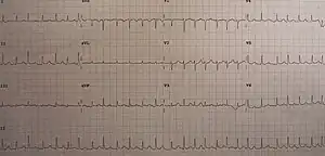 An ECG showing sinus tachycardia and electrical alternans in a person with a pericardial effusion.