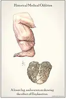 Drawn from the collection at the National Museum of Health and Medicine and shows the effect of elephantiasis in an historic context. Anatomical items: Left Leg, Scrotum.