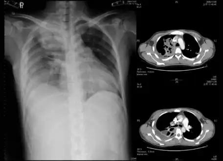 Empyema with abscess