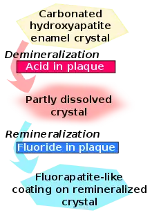Carbonated hydroxyapatite enamel crystal is demineralised by acid in plaque and becomes partly dissolved crystal. This in turn is remineralised by fluoride in plaque to become a fluorapatite-like coating on remineralised crystal.