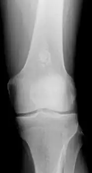 X-ray: Solitary enchondroma in long bone of thigh near knee