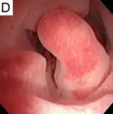 Multiple endometrial polyps