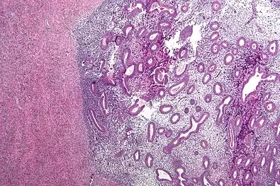 Micrograph showing endometriosis (right) and ovarian stroma (left).