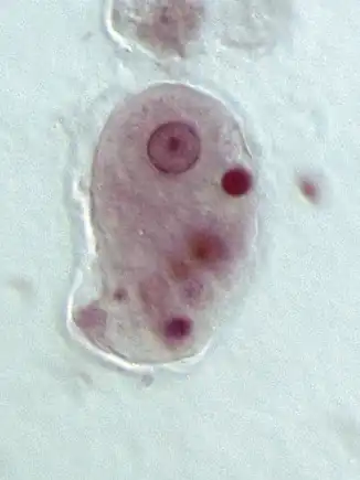 The parasite Entamoeba histolytica that generally attributes to Amoebic Brain Abscesses