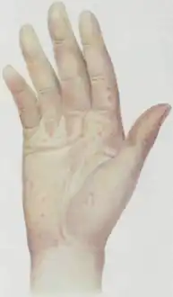 Rash on the volar surface of the hand