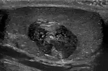 Epidermoid cyst in a testicle on ultrasound, with lamellated ("onion skin") appearance