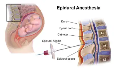 Administration of epidural anesthesia, a procedure to alleviate pain during labor.