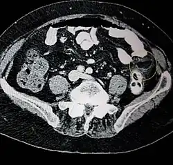 Abdominal CT scan, epiploic appendagitis (circle)