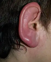 Redness and swelling of an ear