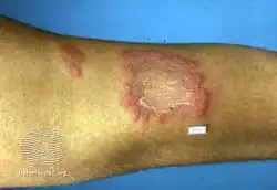 Erythema elevatum diutinum