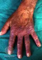 Erythema elevatum diutinum