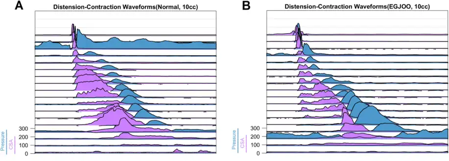 Normal in (A). EGJOO in (B). Pressure waves in blue. Cross-sectional areas CSA) in fucsia.