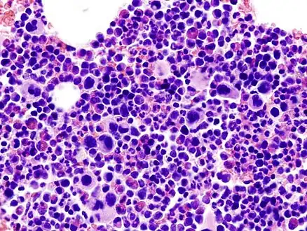 Histopathological image representing a bone marrow aspirate in a patient with essential thrombocythemia