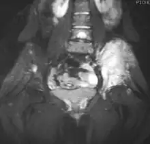 MRI slice showing Ewing sarcoma of the left hip (white area shown right)