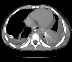 CT scan showing extensive chylothorax caused by leakage from the thoracic duct