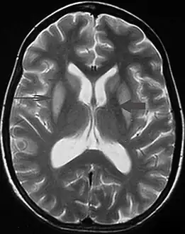 T2 weighted magnetic resonance scan image showing bilaterally symmetrical hyperintensities in caudate nucleus (small, thin arrow), putamen (long arrow), with sparing of globus pallidus (broad arrow), suggestive of extrapontine myelinolysis (osmotic demyelination syndrome)