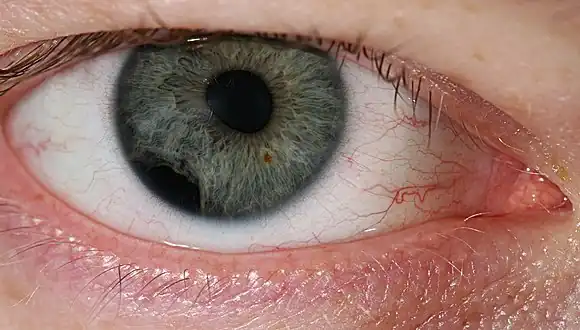 Eye injury by impact of small plastic body