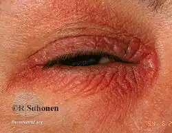 Eyelid contact dermatitis