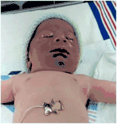 Facial duskiness due to tight nuchal cord