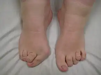 Feet of a person with Larsen syndrome: Note the small size and joint abnormalities.