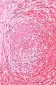 Micrograph showing a thrombus (center of image) within a blood vessel of the placenta. H&E stain.