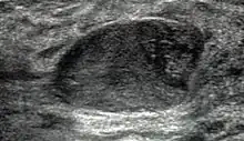 Fibroadenoma in ultrasound
