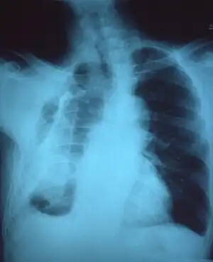 Chest x-ray showing fibrous opacity on one side