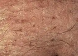 Pubic lice on the abdomen