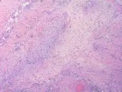 Myxofibrosarcoma-pathology