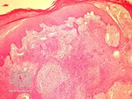 Botryomycosis