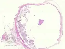 pathology-Bronchogenic cyst
