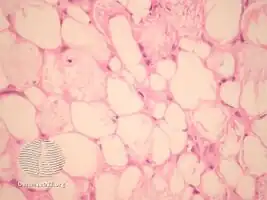 Sclerema neonatorum/pathology