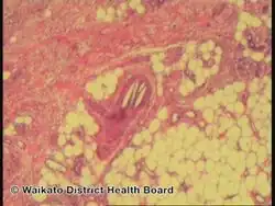 Cholesterol emboli/pathology