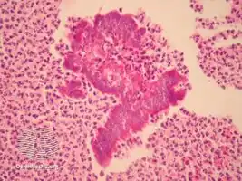 Botryomycosis