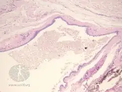 pathology-Cutaneous ciliated cyst